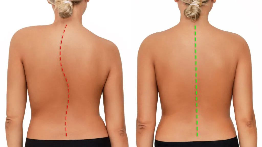 https://spinalrehabandchirocenter.com/wp-content/uploads/2023/10/young-woman-with-crooked-straight-spine-isolated-white-background-scoliosis-1-1024x576.jpg